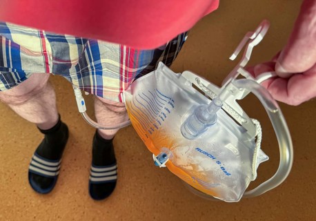 Man in hospital, after urological surgery, with urine bag on a urinary catheter