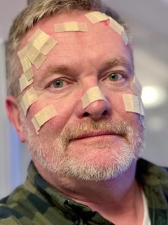 Man with many small wound patches on his face, after a laser treatment at the dermatologist, for