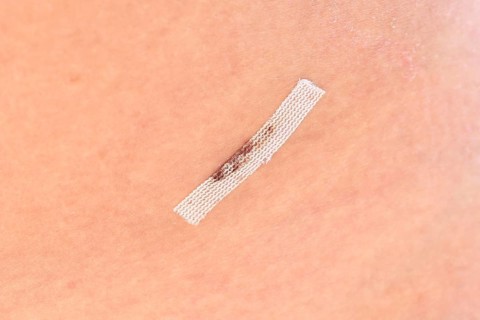 Close up of sterile wound closure strip used on cut after laparoscopy on woman's lower abdomen