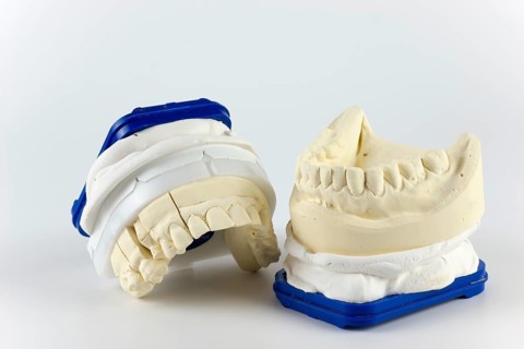 Two dental plaster casts with a blue border on a white background, representing the upper and lower