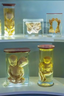 Anatomical collection, specimens, wet preparation. Skeleton, human, deformity, research, medicine,