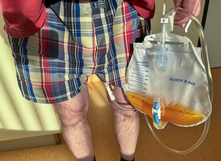 Man in hospital, after urological surgery, with urine bag on a urinary catheter