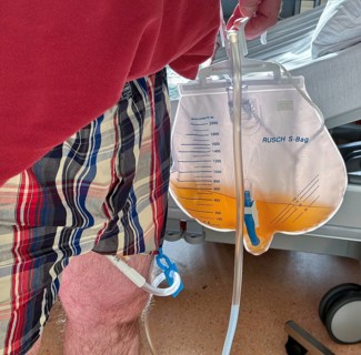 Man in hospital, after urological surgery, with urine bag on a urinary catheter