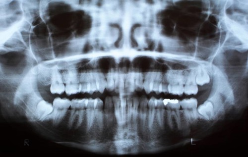 Dental X-Ray from a mouth with one tooth filling and a three intact wisdom teeth