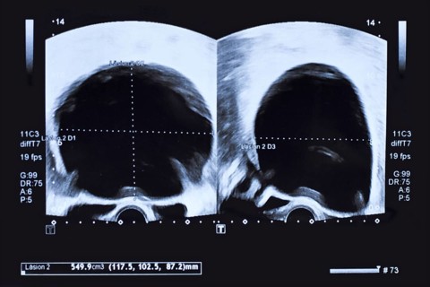 Ultrasound image of large round cyst in lower abdomen of woman printed on a piece of paper