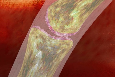 Joint inflammation is typical for rheumatism