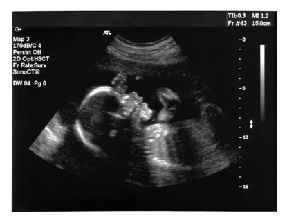 Ultrasound imaging of a baby. Five months old fetus