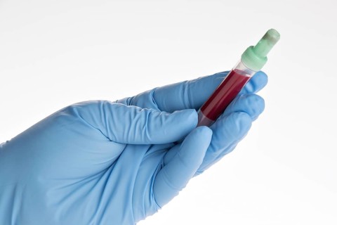 Blood samples are taken on a laboratory form to determine the blood values