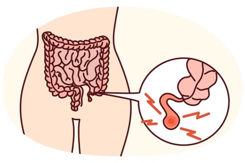 Closeup of human body with inflamed appendix. Person suffer from appendicitis need surgery. Vector