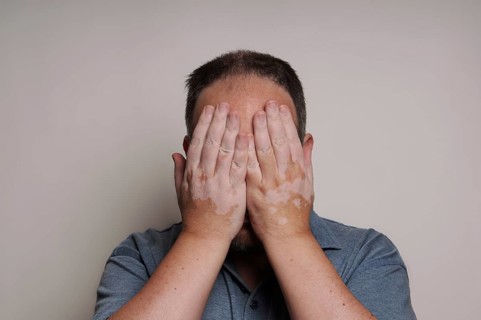 man affected by Vitiligo skin condition hiding his face