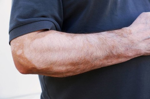 Vitiligo is a medical condition causing depigmentation of patches of skin