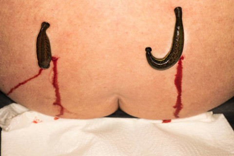 Two medicinal leeches (Hirudo medicinalis) were applied to the left and right of the spine, blood