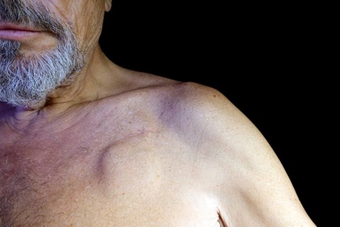Elderly man with a pacemaker, studio photography with black background