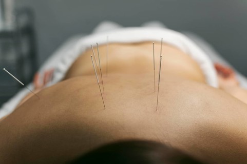 Acupuncture process client