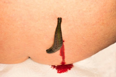 A medicinal leech (Hirudo medicinalis) has been applied to the right side of the spine and blood is