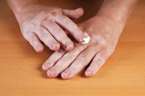 Vitiligo or white spot disease