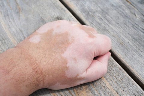 male hand with vitiligo skin condition, characterized by white unpigmented patches or blotches
