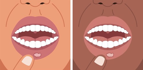 Vector illustration canker sore, aphthous ulcer on the lip, stomatitis