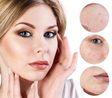 Portrait of young woman and circles shows problem skin