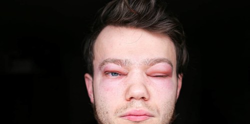 A person with a swollen eye partially closed in moderate lighting allergic reaction on the lip