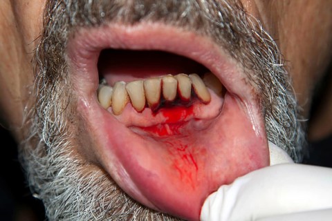 Symbolic image for periodontitis, heavily bleeding gums