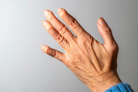 Close up view of a hand exhibiting swollen finger joints, emphasizing the painful effects of
