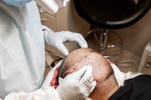 Doctor performing hair transplant. Surgeons in the operating room carry out hair transplant surgery