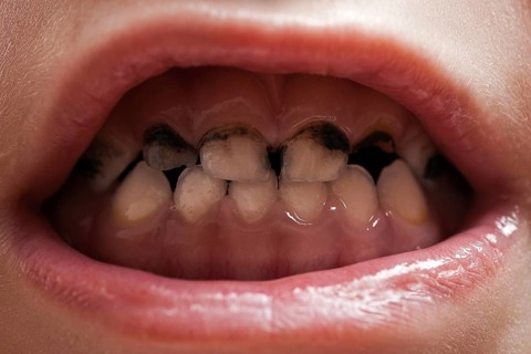 Dental medicine and healthcare, human patient open mouth showing caries teeth decay