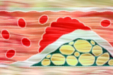 Arteriosclerosis is a common vascular disease in which the arteries become narrowed and hardened by
