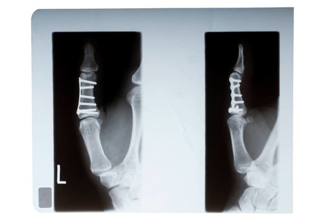 Thumb bone nailed in X-ray image