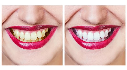 Whitening - bleaching treatment, before and after, woman teeth and smile isolated on white