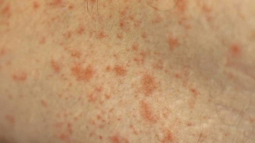 Close up to patches of inflammation called milk rash or atopic dermatitis on an adult caucasian