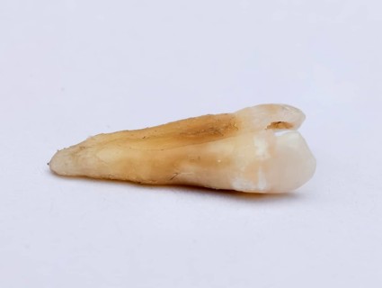 Pulled out cracked and damaged tooth, second premolar on a white background. Karaganda, Kazakhstan