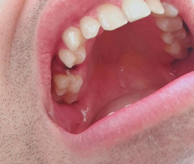 Open mouth of a man with the place of a pulled out small molar tooth, healing of a wound in the