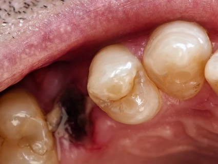 Open mouth of a man with the place of a pulled out small molar tooth, healing of a wound in the