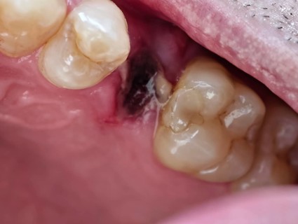 Open mouth of a man with the place of a pulled out small molar tooth, healing of a wound in the
