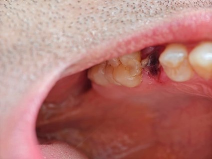 Open mouth of a man with the place of a pulled out small molar tooth, healing of a wound in the