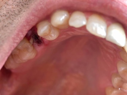Open mouth of a man with the place of a pulled out small molar tooth, healing of a wound in the