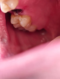 Open mouth of a man with the place of a pulled out small molar tooth, healing of a wound in the