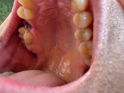 Open mouth of a man with the place of a pulled out small molar tooth, healing of a wound in the