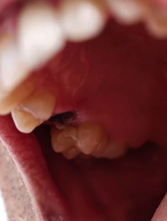 Open mouth of a man with the place of a pulled out small molar tooth, healing of a wound in the