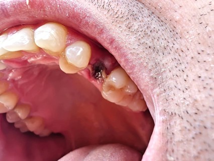 Open mouth of a man with the place of a pulled out small molar tooth, healing of a wound in the