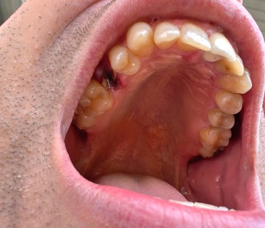 Open mouth of a man with the place of a pulled out small molar tooth, healing of a wound in the