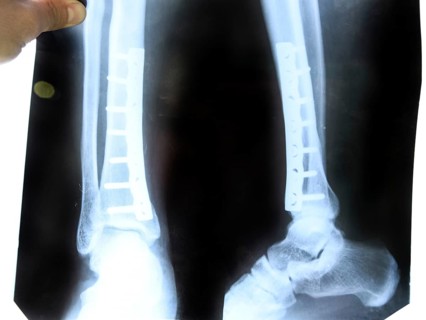 X-ray of the leg. Atyrau, Kazakhstan