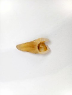 Pulled out, cracked, and damaged tooth, second premolar on a white background, Karaganda,
