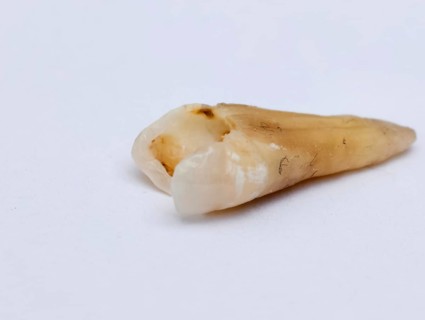 Pulled out, cracked and damaged, tooth, second premolar on a white background. Karaganda,