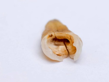 Pulled out, cracked and damaged, tooth, second premolar on a white background, Karaganda,