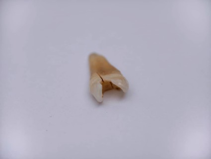 Pulled out, cracked and damaged tooth, second premolar on a white background. Karaganda, Kazakhstan