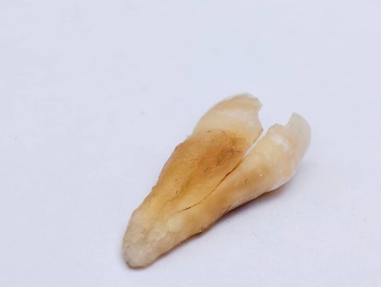 Pulled out cracked and damaged tooth, second premolar on a white background. Karaganda, Kazakhstan