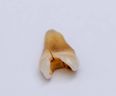 Pulled out cracked and damaged tooth, second premolar on a white background. Karaganda, Kazakhstan
